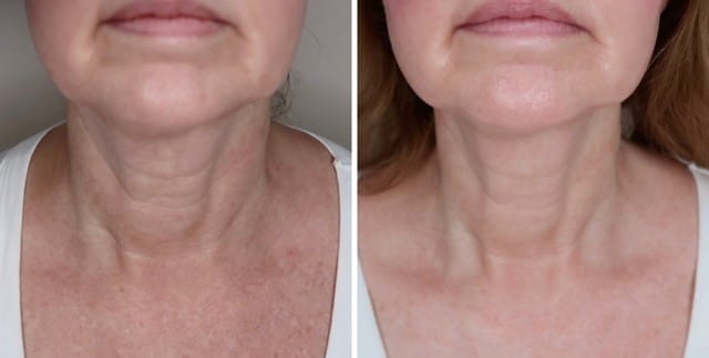 Masajeador Facial LED con Vibración💆‍♀️ - Piel Firme y Radiante sin Cirugía✨